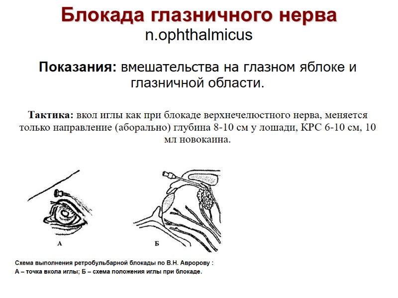 Блокада глазничного нерва n.ophthalmicus Показания: вмешательства на глазном яблоке и глазничной области. Тактика: Блокада глазничного нерва n.ophthalmicus Показания: вмешательства на глазном яблоке и глазничной области. Тактика:
